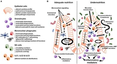 Current Understanding of Innate Immune Cell Dysfunction in Childhood Undernutrition